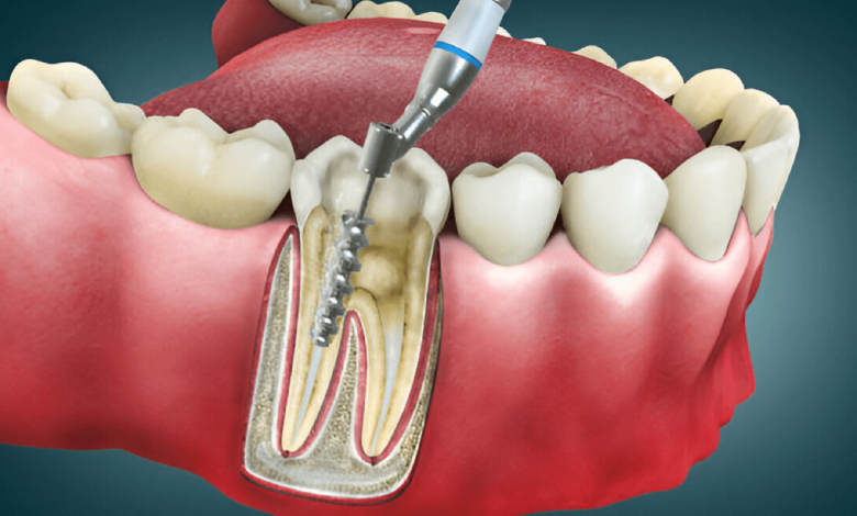 Root Canal Treatment