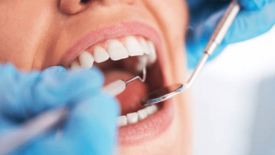 A Modern Solution for Tooth Decay: The Story Behind Composite Fillings