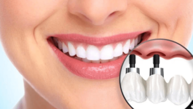 Rebuilding Smiles with Confidence: The Story of Dental Implants