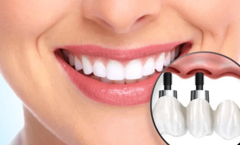 Rebuilding Smiles with Confidence: The Story of Dental Implants